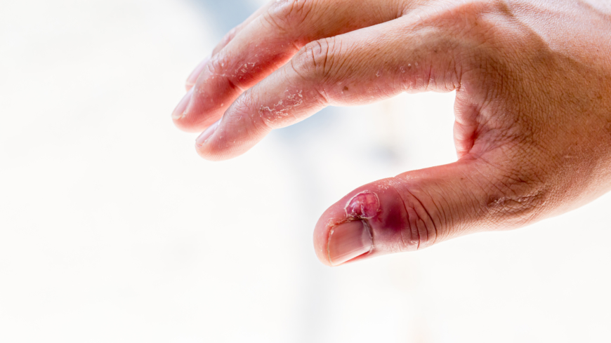 Nagelbandsinfektion (paronyki): orsak, symtom & egenvård